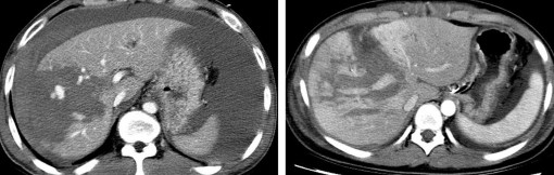 Hình 1 19 CTG độ IV Rách nhu mô 50 thùy gan phải Hình 1 20 CTG độ IV rách nhu mô 5