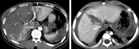 Hình 1 21 CTG độ V Rách nhu mô gan thùy gan P và thùy gan T Hình 1 22 CTG độ V Vết 6