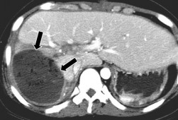 Hình 1 25 Áp xe gan sau CTG trên phim chụp CLVT mũi tên Nguồn Shanmuganathan K Mirvis SE 7