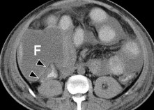 Hình 1 27 Viêm phúc mạc mật Chụp CLVT không tiêm thuốc cản quang thu được sau 5 8