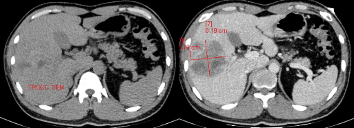 Hình 4 1 CTG độ III tổn thương dạng đụng dập nhu mô gan HPT VI – VIII trước T 1