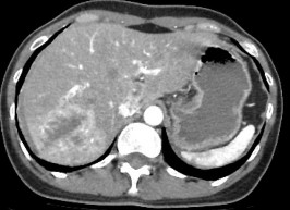 Hình 4 2 CTG độ III Tụ máu dưới bao 7mm Phân thùy sau có đường vỡ kèm tụ máu 2