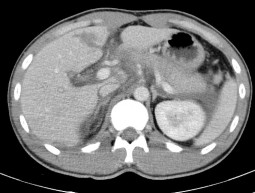Hình 4 3 CTG độ III tổn thương rách nhu mô hạ phân thùy IV dạng các đường 3
