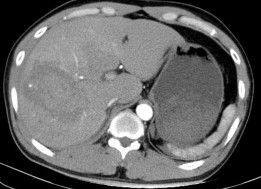 Hình 4 4a CTG độ IV Nhu mô HPT VII VIII có vùng tổn thương ở giữa có phần tăng 4