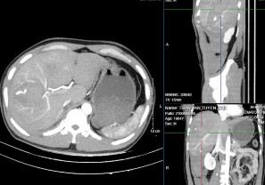 Hình 4 4b CTG độ IV thì ĐM Hình4 4c Thuốc thoát nhiều hơn ở thì muộn Nguồn BN 5