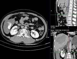 Hình4 4c Thuốc thoát nhiều hơn ở thì muộn Nguồn BN Trần Văn T 37t HS 008434845 6