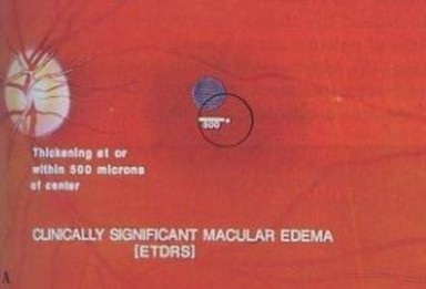 Hình 1 4 Tiêu chuẩn chẩn đoán phù hoàng điểm theo EDTRS 1 2 Phù hoàng điểm kèm 4