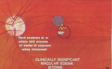 Hình 1 5 Tiêu chuẩn chẩn đoán phù hoàng điểm theo EDTRS 2 3 Có vùng phù dày võng 5