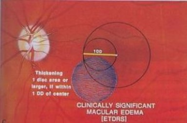 Hình 1 6 Tiêu chuẩn chẩn đoán phù hoàng điểm theo EDTRS 3 1 2 2 Phân loại phù 6