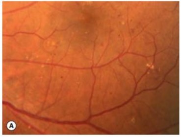 Hình 1 7 Vi phình mạch trên ảnh màu đáy mắt Nguồn ảnh Jack Kanski Bowling B 2015 32 1