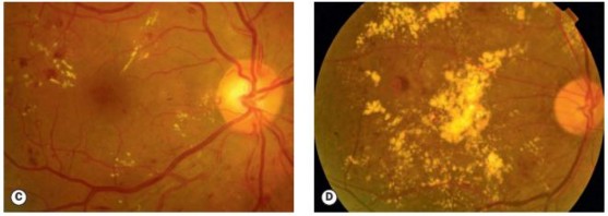 Hình 1 8 C xuất tiết cứng kèm theo vi phình mạch D xuất tiết cứng Nguồn ảnh 2