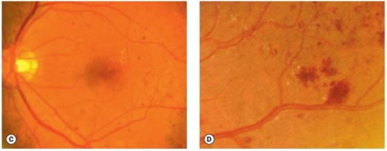Hình 1 9 C chấm nốt xuất huyết võng mạc D đám nhồi máu võng mạc Nguồn ảnh 3