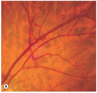 Hình 1 10 Tân mạch võng mạc Nguồn ảnh Jack Kanski Bowling B 2015 32 1 2 4 2 Chụp cắt 4