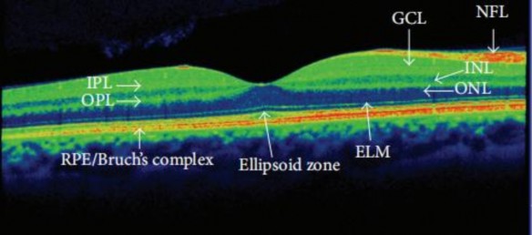 Hình 1 11 Các lớp võng mạc vùng hoàng điểm bình thường trên OCT 30 RPE Bruch’s 5