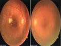 Đặc điểm lâm sàng và phim OCT của bệnh nhân phù hoàng điểm do đái tháo đường tại Bệnh viện Mắt trung ương - 8