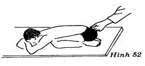 Áp dụng thủ thuật bỉ song chỉnh theo hướng thẳng từ trong ra ngoài đối với 14