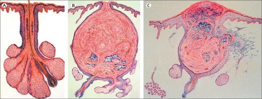 Hình 2 1 Nang tuyến bã nhờn Degitiz et al 2007 A Nang tuyến bã nhờn bình thường B 1