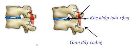 Hình 2 Hình ảnh khe khớp toác rộng hơn bên khe khớp đối diện 3 2 2 MRI xác 1