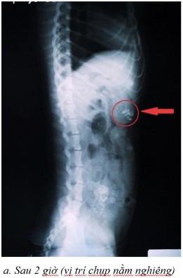 Phụ lục 5 1 Hình ảnh X quang chó 2 ở thời điểm a sau 2 giờ ở vị trí nằm 4