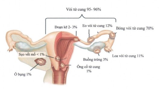 Hình 1 2 Vị trí CNTC 40 Sự tiến triển của chửa ngoài tử cung Khi trứng làm tổ 2