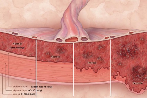 Hình 1 1 Phân loại rau cài răng lược 2 RCRL có thể chiếm một phần hoặc toàn 1