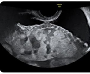 Hình 1 2 Hình ảnh xoang mạch máu trong bánh rau 14 Tiêu chuẩn 3 mất hình ảnh 2