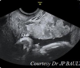 Hình 1 2 Hình ảnh xoang mạch máu trong bánh rau 14 Tiêu chuẩn 3 mất hình ảnh 3