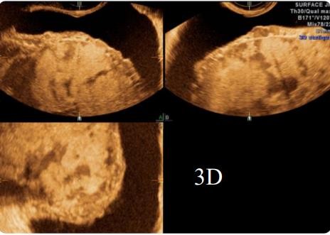 Hình 1 3 Hình ảnh bất thường ở thành bàng quang 31 Hình 1 4 Hình ảnh siêu âm 4