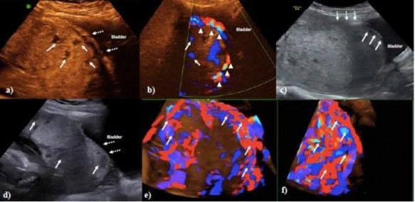 Hình 1 4 Hình ảnh siêu âm doppler màu RCRL 30 Theo các tiêu chuẩn mô tả trong Y văn 5