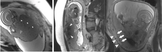 Hình 1 5 MRI rau cài răng lược 32 α Fetoprotein theo B Courbieres nồng độ αFP và 1