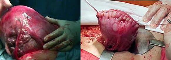 Hình 1 6 Rạch ngang đáy tử cung lấy thai và khâu bảo tồn tử cung 34 Tránh bóc 2