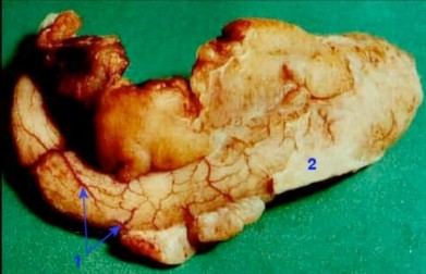 Hình 1 2 Hình ảnh GPB đại thể viêm ruột thừa Hình ảnh vi thể của viêm ruột 2