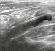 Hình 1 4 Viêm ruột thừa điển hình Với thành dày và đường kính mặt cắt 9mm 2