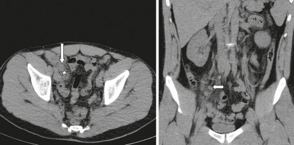 Hình 1 5 CLVT không cản quang ở bệnh nhân VRTC Dấu sao Hình ảnh dày thành mũi tên 1
