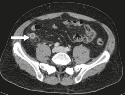 Hình 1 6 CLVT có tiêm thuốc cản quang trên bệnh nhân VRTC 35 Hình 1 7 Hình ảnh VRTC 2