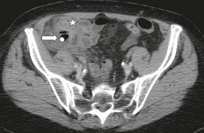 Hình 1 7 Hình ảnh VRTC có vôi hóa hình thành ổ áp xe 35 Theo nhiều nghiên cứu 3