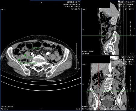 Hình 3 8 BN Nguyễn Thị X được chẩn đoán VRTC trên CLVT Bệnh nhân Nguyễn Thị X 2