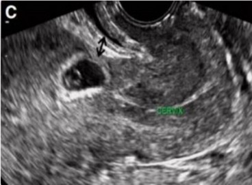 Hình 1 2 Hình ảnh túi ối ở SMLT qua siêu âm đường âm đạo 20 Hình 1 3 Hình 1