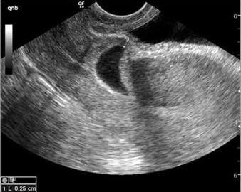 Hình 1 3 Hình ảnh BTC và ống CTC rỗng túi thai làm tổ tại cơ tử cung mặt 2