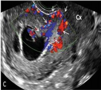 Hình 1 4 Hình ảnh tăng sinh mạch máu vùng sẹo mổ lấy thai 23 Siêu âm 3D cũng 3
