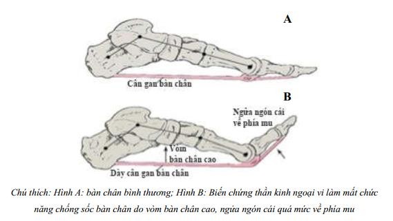 Hình 1 1 Mất chức năng chống sốc bàn chân do biến chứng thần kinh ngoại vi 16 1