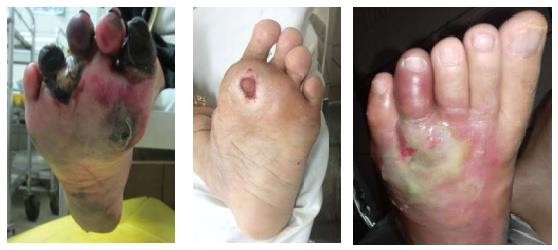 Hình 1 3 Loét mạch máu trái loét thần kinh giữa loét nhiễm trùng phải 1 2 6 3