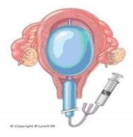 Hình 1 1 Bóng Sengstaken Blakemore Hình 1 2 Bóng Rüsch Hình 1 3 Bóng Bakri 1 7 3 1 Ống 1