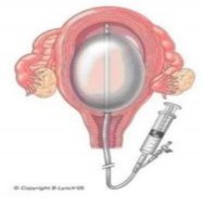 Hình 1 2 Bóng Rüsch Hình 1 3 Bóng Bakri 1 7 3 1 Ống thông Sengstaken Blakemore Ống 2
