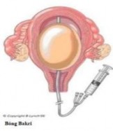 Hình 1 3 Bóng Bakri 1 7 3 1 Ống thông Sengstaken Blakemore Ống thông thực quản 3
