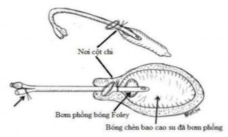 Hình 1 6 Bóng chèn bao cao su với ống thông Foley Nguồn Available hemostatic measures 2