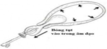 Hình 1 7 Bóng tụt vào trong âm đạo Nguồn An effective addition of uterine balloon 3