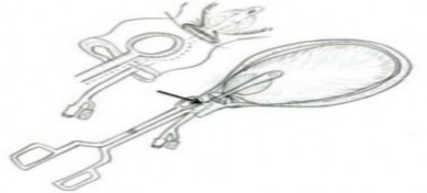 Hình 1 8 Phương pháp chèn bóng và kẹp cổ tử cung Nguồn An effective addition of 4