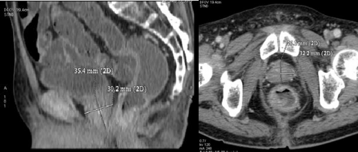 lưng Hình B Hình ảnh chụp CT sau điều trị 6 tháng Sau 36 tháng điều trị bệnh 1