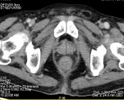 Hình C Hình ảnh chụp CT tại thời điểm kháng cắt tinh hoàn Bệnh nhân được 2